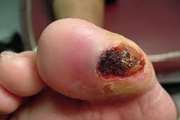 برگزار ی اولین کنفرانس بیمارستان سینا در  سال 90 با موضوع  Diabetic foot